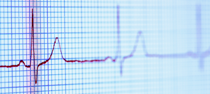 New guidelines aim to prevent sudden cardiac death - Alpine Cardiology