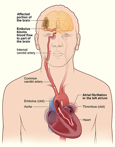 Alpine Cardiology Atrial Fibrillation Stroke