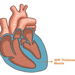 Preserved ejection fraction